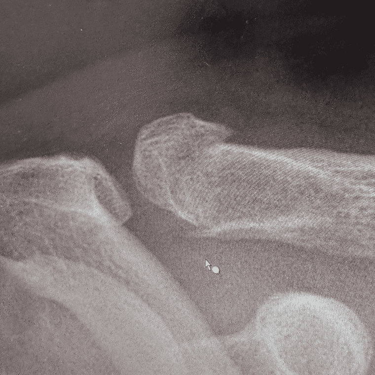Tom's clavicle fracture X-Ray.